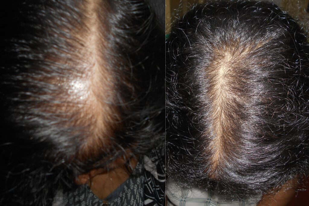 Is hair transplantation a safe technique  to restore hair growth? 