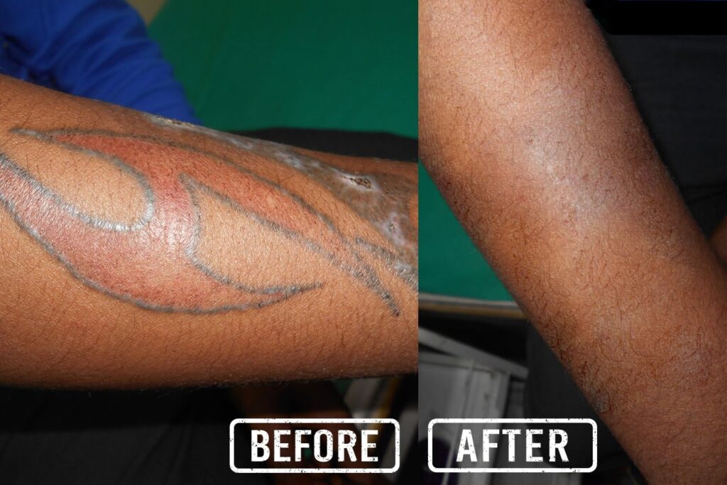 Why Should Consider Laser Treatment for Removing Permanent Tattoos?