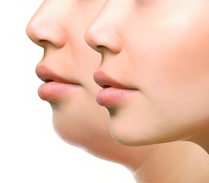 Non-Surgical Treatments to Lose Double-Chin & Get a Slimmer Jawline