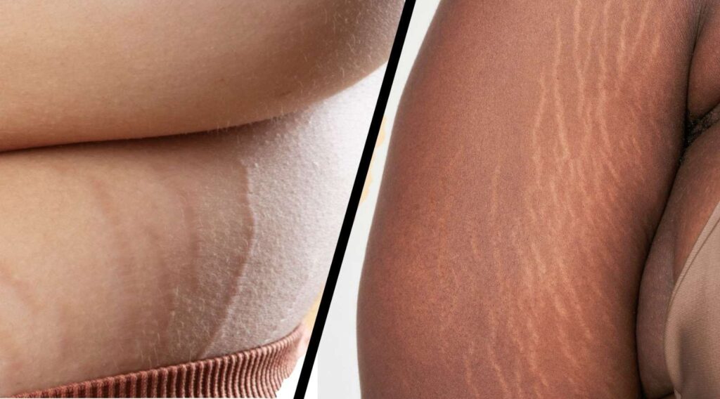 Discover 5 Effective & Non-Surgical Treatments to Get Rid of Stretch Marks Permanently