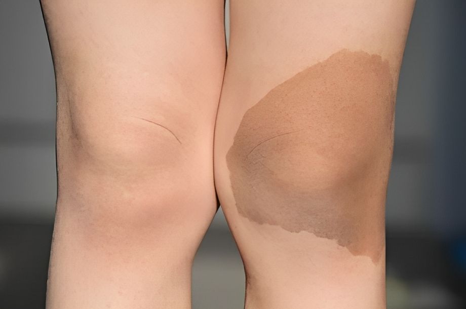 Is it possible to remove birthmarks with laser therapy?