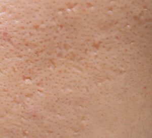 Scars from Ice Pick Acne