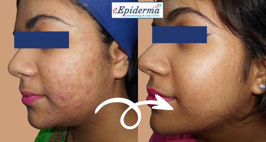 How Well Do Laser Treatments Work in Treating Pimples and Acne Scars? Learn about the best acne scar treatment!