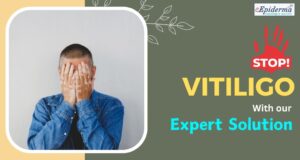 A New Hope for the Vitiligo Patient: What Are the Best Treatment Options for Vitiligo?